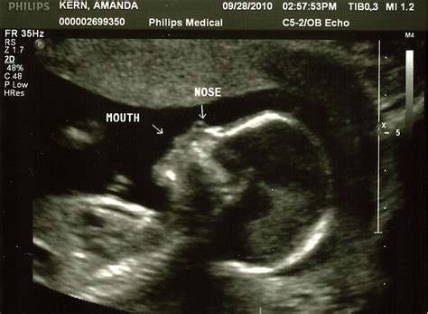 Spina Bifida Ultrasound