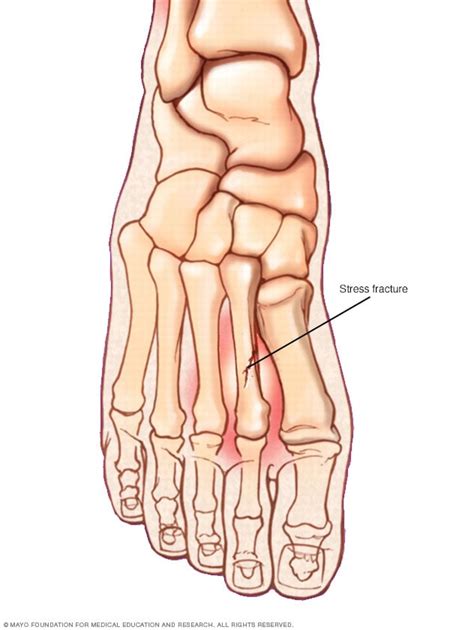 Stress fracture - Mayo Clinic