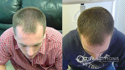 Laser Hair Therapy - LLLT Hair Loss Treatment for Androgenetic Alopecia