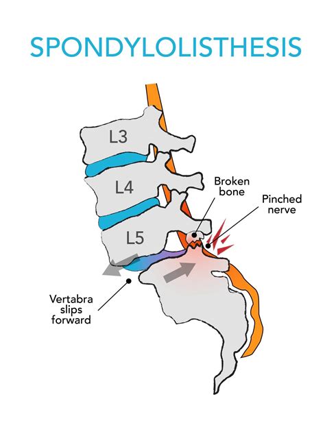 6 best spondylolisthesis exercises and 3 to avoid – Artofit