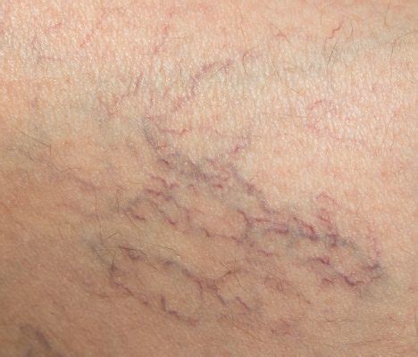 What is the Best Laser for Spider Veins? It depends! Advice from an Expert