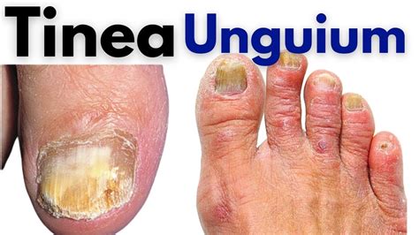 Tinea unguium infection | nail fungus treatment at home | Nail fungus ...