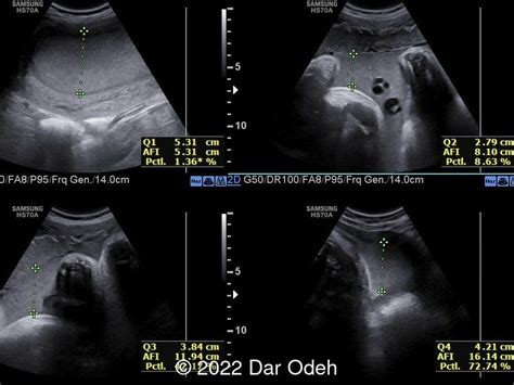 📃 Highly echogenic amniotic fluid