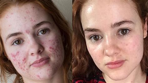 This Woman's Accutane Transformation Photos Went Viral — Before and After Acne Photos | Allure