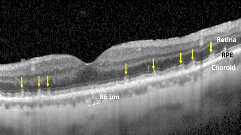 Age-Related Macular Degeneration Linked to Severe Vascular Disease ...