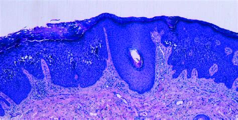 Erythematous plaques and circinate lesions on the lower extremities | Download Scientific Diagram