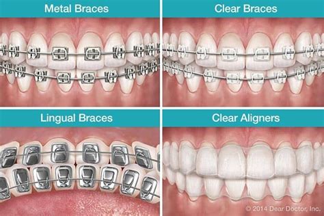 Teeth Braces And It's Types