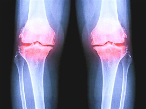 Osteoarthritis of the Knee X-Ray