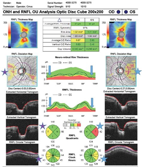 Look to RNFL Thickness When Distinguishing Glaucoma from Myopia