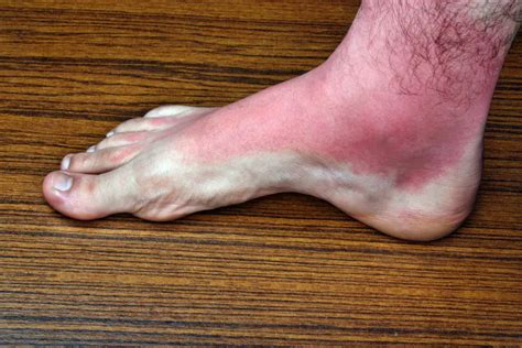 Foot rash | causes, symptoms, home remedies & treatment, pictures