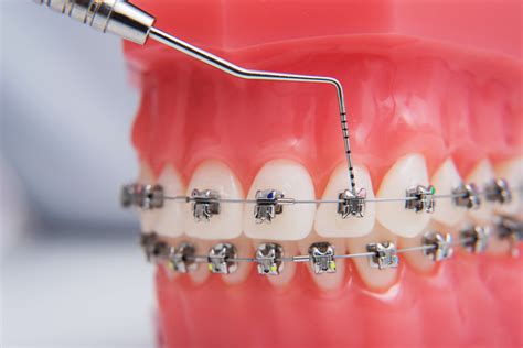 How Many Types Of Wires Are There For Braces at Glenn Medeiros blog