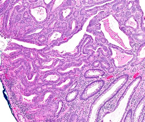 Tubular Adenoma Histology