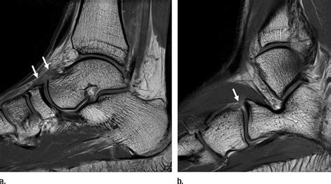 Transverse tarsal joint sprain in a 19-year-old professional rugby ...