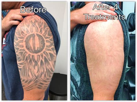 Laser Tattoo Removal Before and After update -2021 - Tattoo Shoo | Tattoo removal, Laser tattoo ...