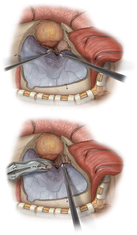 Lateral and Middle Sphenoid Wing Meningioma | The Neurosurgical Atlas, by Aaron Cohen-Gadol, M.D.