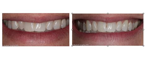 Feldspathic Veneer | Peg Lateral | Elizabeth Caughey DDSElizabeth Caughey DDS