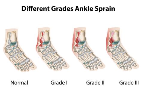 Ankle Sprain - Corona Foot and Ankle | Wound Care Center