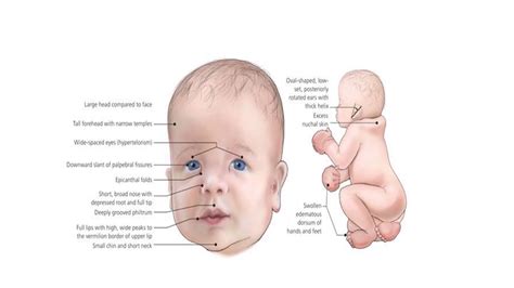 Velocardiofacial Syndrome Life Expectancy