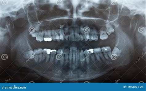 X-Ray of Problematic Wisdom Teeth Stock Photo - Image of problem ...