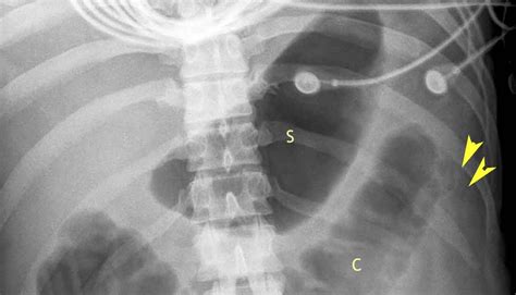 RiT radiology: Colon Cutoff Sign