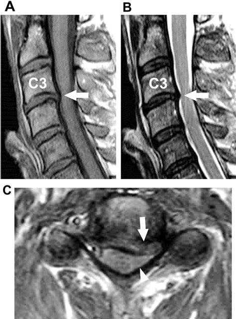 Cervical cord compression on MRI. (A) T1- and (B) T2-weighted sagittal... | Download Scientific ...