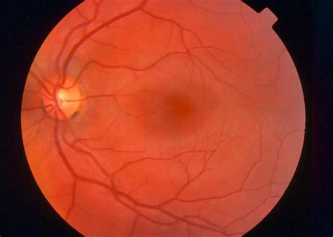 Normal fundus - American Academy of Ophthalmology