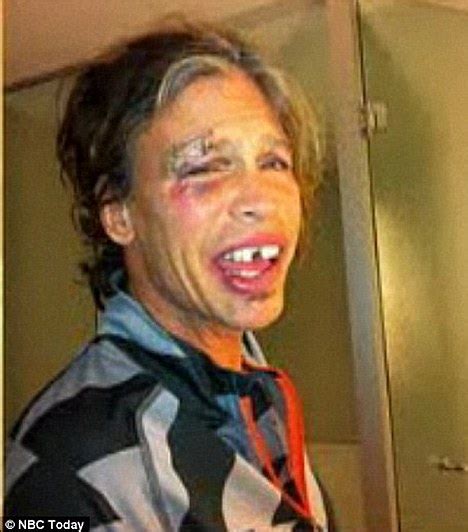 Aerosmith's Steve Tyler shows off bruised and battered face from shower ...