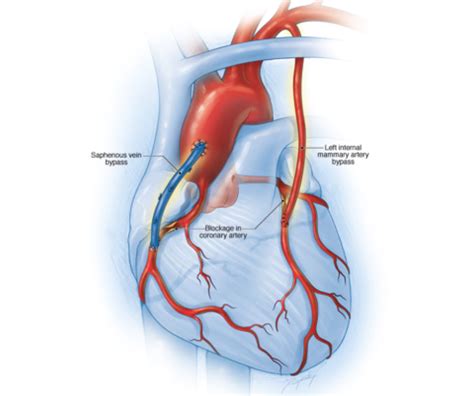 Coronary Artery Bypass Graft Surgery in Nagpur - Swasthyam Hospital