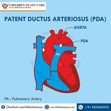 Patent Ductus Arteriosus Stent Versus Surgical, 59% OFF