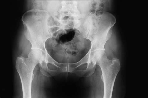 Pain Relief for a Broken Pelvis | LIVESTRONG.COM