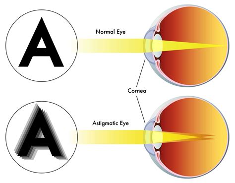 What Causes Astigmatism? - Heffington's of Springfield, MO