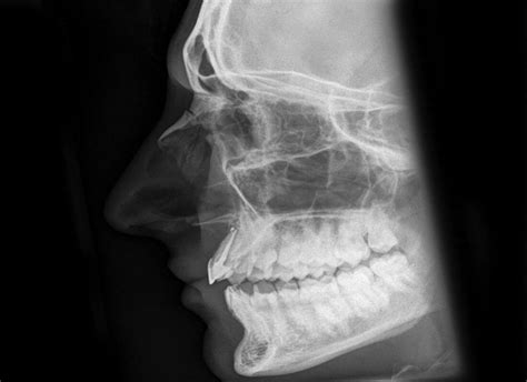 Broken nose | Nasal Bone Fracture aetiology and management