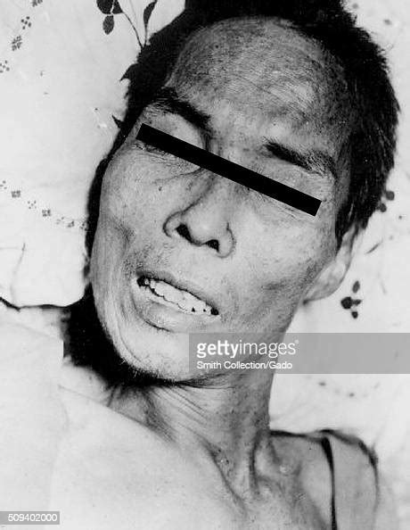 Face of man with tetanus. Tetanus in a 46-year-old man, Manila.... News ...