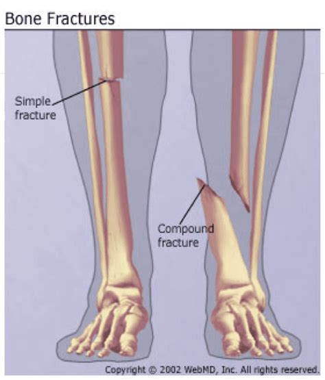 Compound Fracture Left Femur - Foto Kolekcija