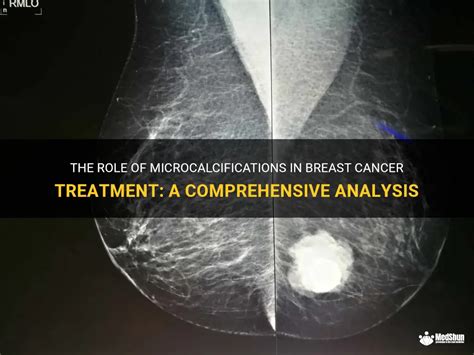 The Role Of Microcalcifications In Breast Cancer Treatment: A ...