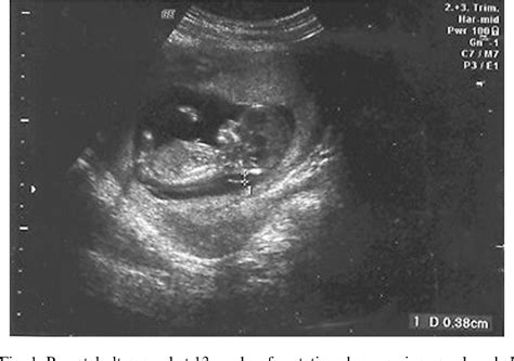 Figure 2 from Osteogenesis imperfecta type II: prenatal diagnosis and association with increased ...