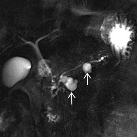 Pancreatic IPMN | Clinical Gate