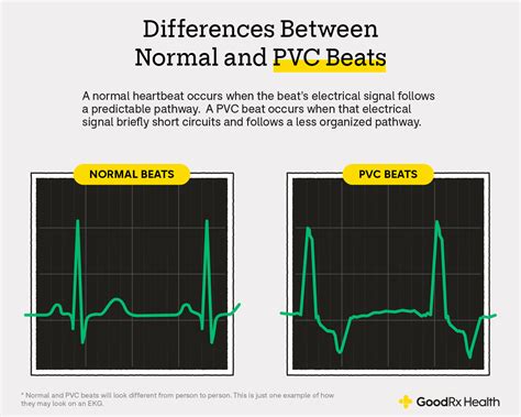 A Premature Ventricular Contractions Pvcs Uniform In - vrogue.co