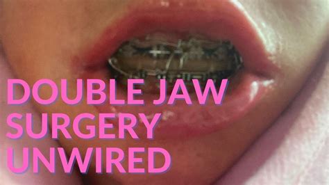 Jaw Surgery Wired Shut