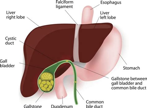 Treatment for Gallstones - Facty Health