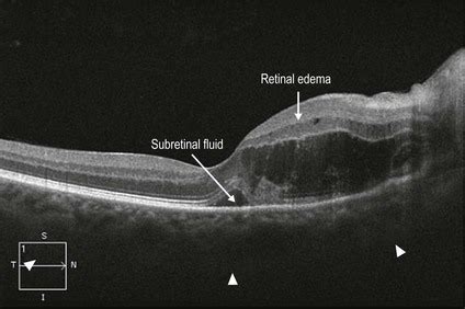 Multifocal Choroiditis | Clinical Gate