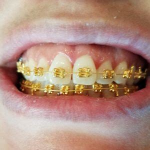 Gold Braces Las Vegas - Nevada Dentistry & Braces