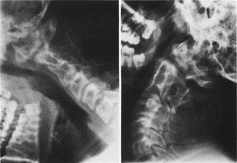 Familial os odontoideum in: Journal of Neurosurgery Volume 70 Issue 4 (1989)