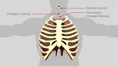 Tracheal resection | Thoracic Surgery University Hospitals Birmingham