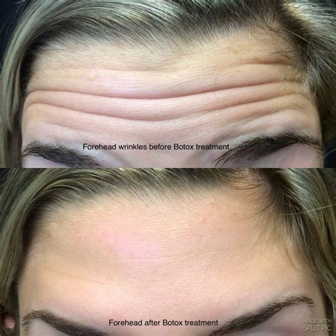 Botox Before and After Pictures - Deep Forehead Wrinkle, Lips