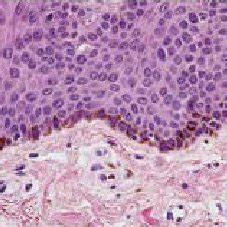 A brown macule on the vermilion border of the lower lip. | Download Scientific Diagram