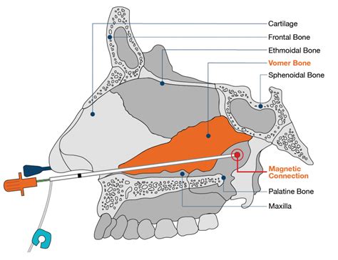 AMT Bridle™ Nasal Tube Retaining System | Applied Medical Technology