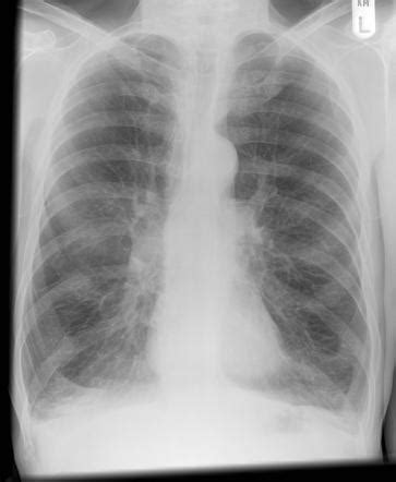 Chronic obstructive pulmonary disease | Radiology Reference Article | Radiopaedia.org