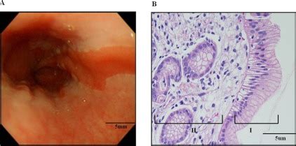 Endoscopic finding of esophagus shows irregular Z-line, elongated ...