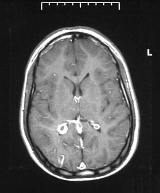 Sturge Weber Mri